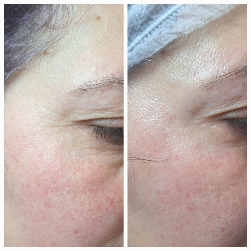 Hydrafacial și Intraceuticals