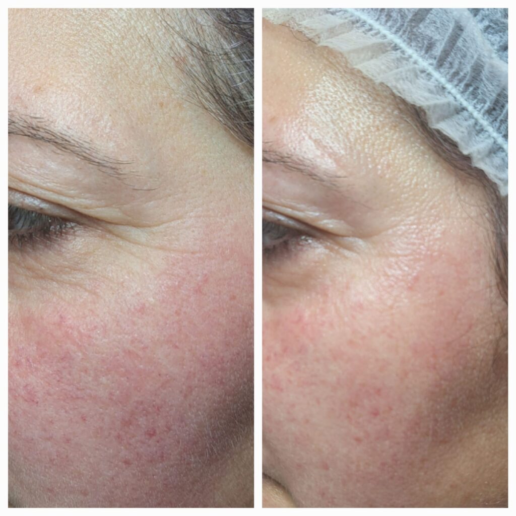 Hydrafacial și Intraceuticals