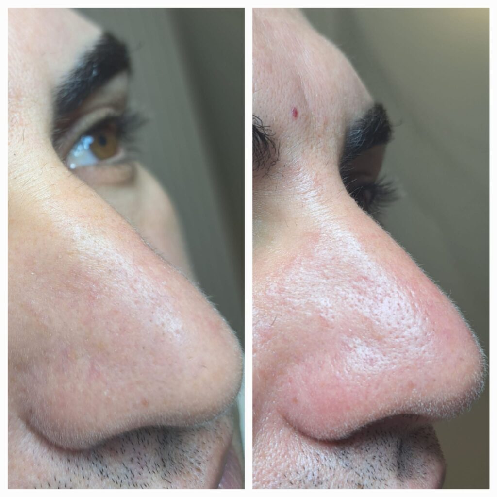 Hydrafacial și Intraceuticals