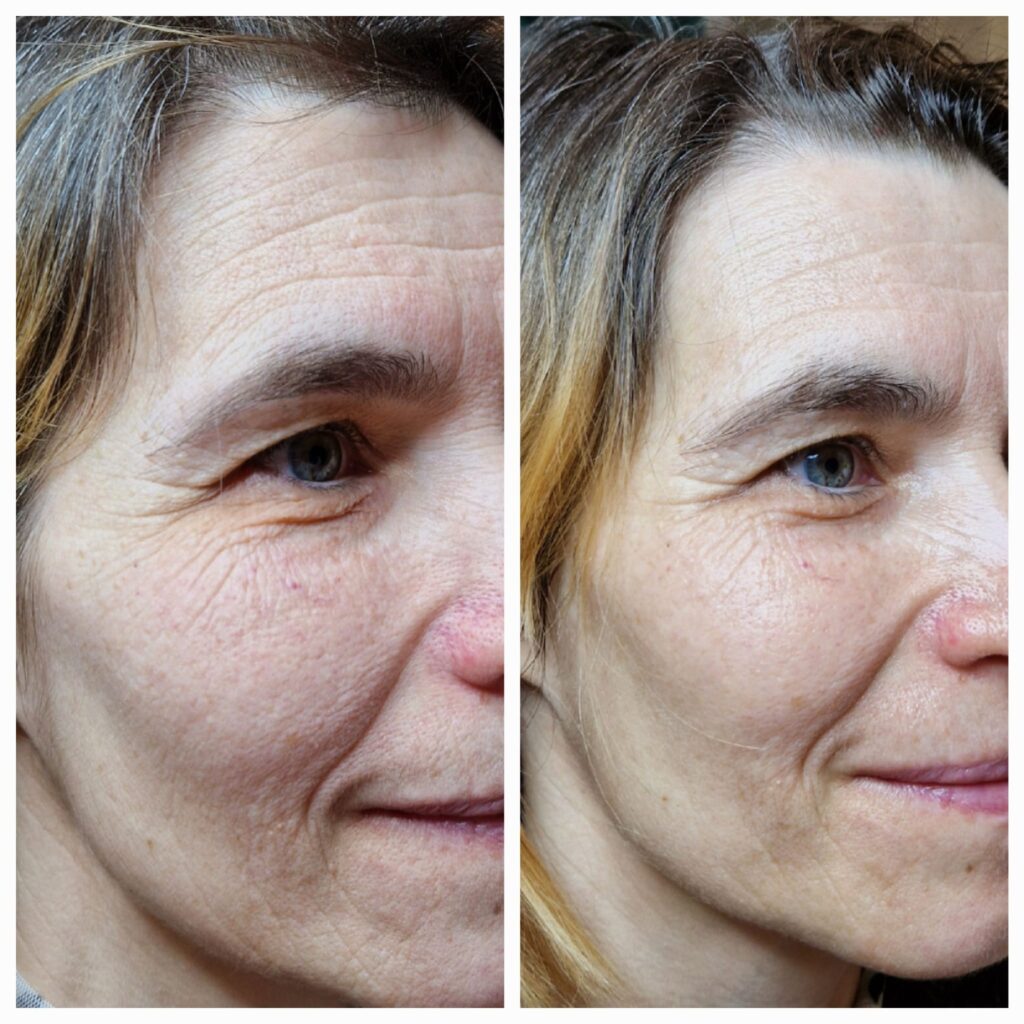 Hydrafacial și Intraceuticals