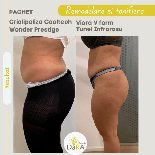 Remodelare corporală